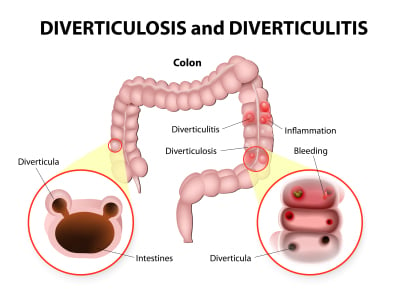 Understanding Diverticulitis